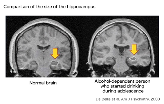 Comparison of the size of the hippocampus